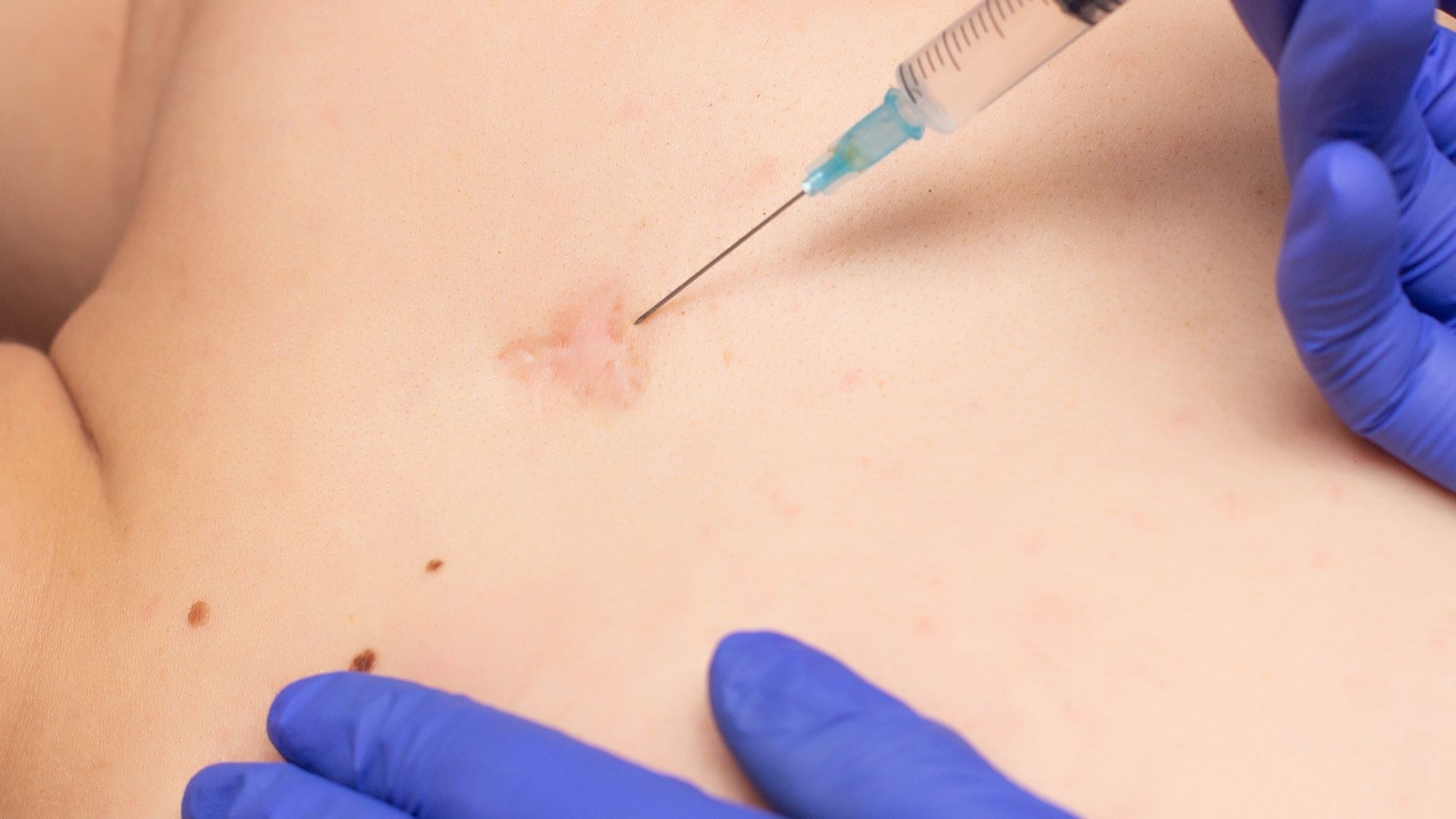 Mesotherapy PRP 2 Mezoterapi Hangi Durumlarda Uygulanir