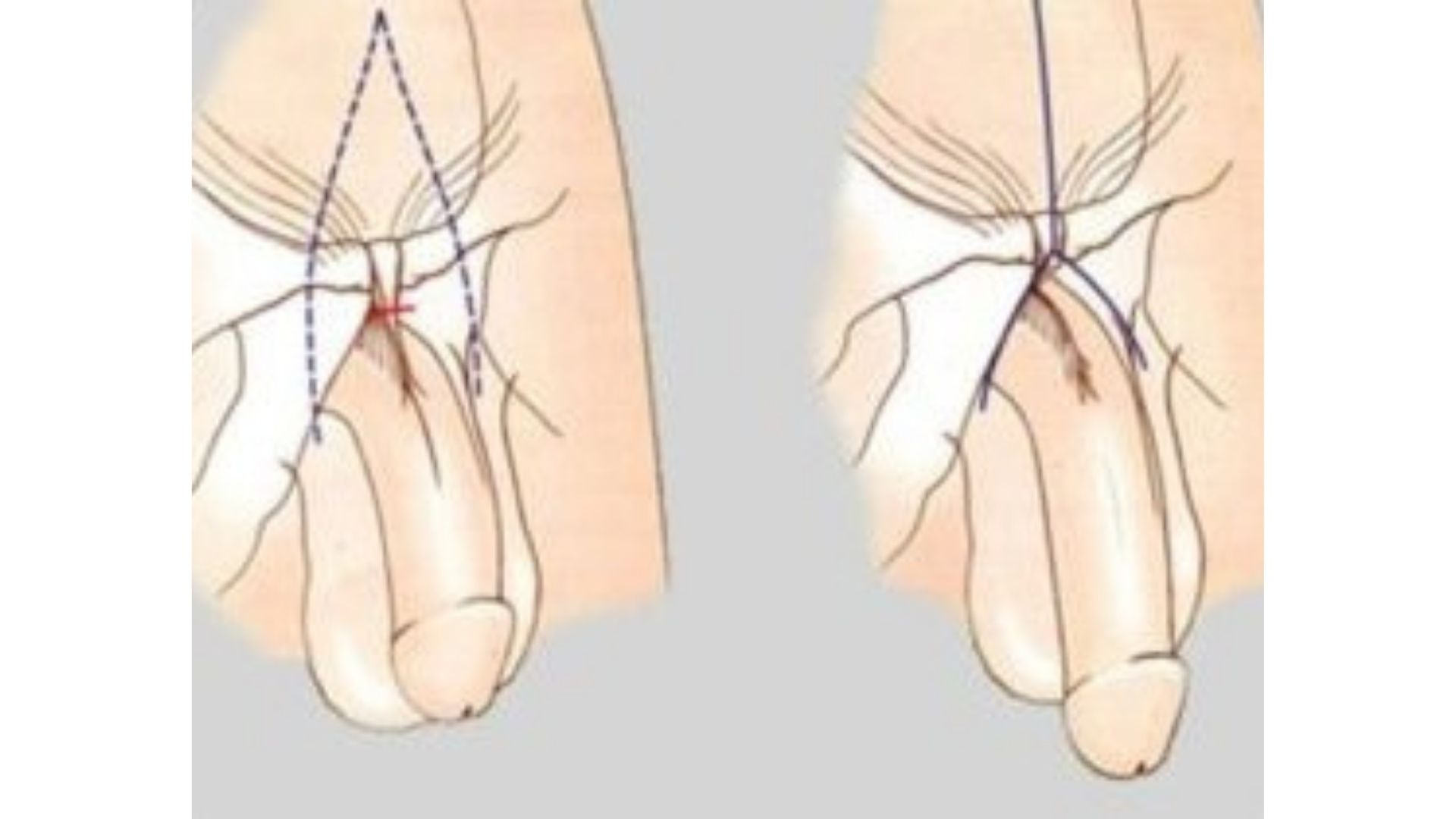 Penis Buyutme Ameliyati Nasil Yapilir