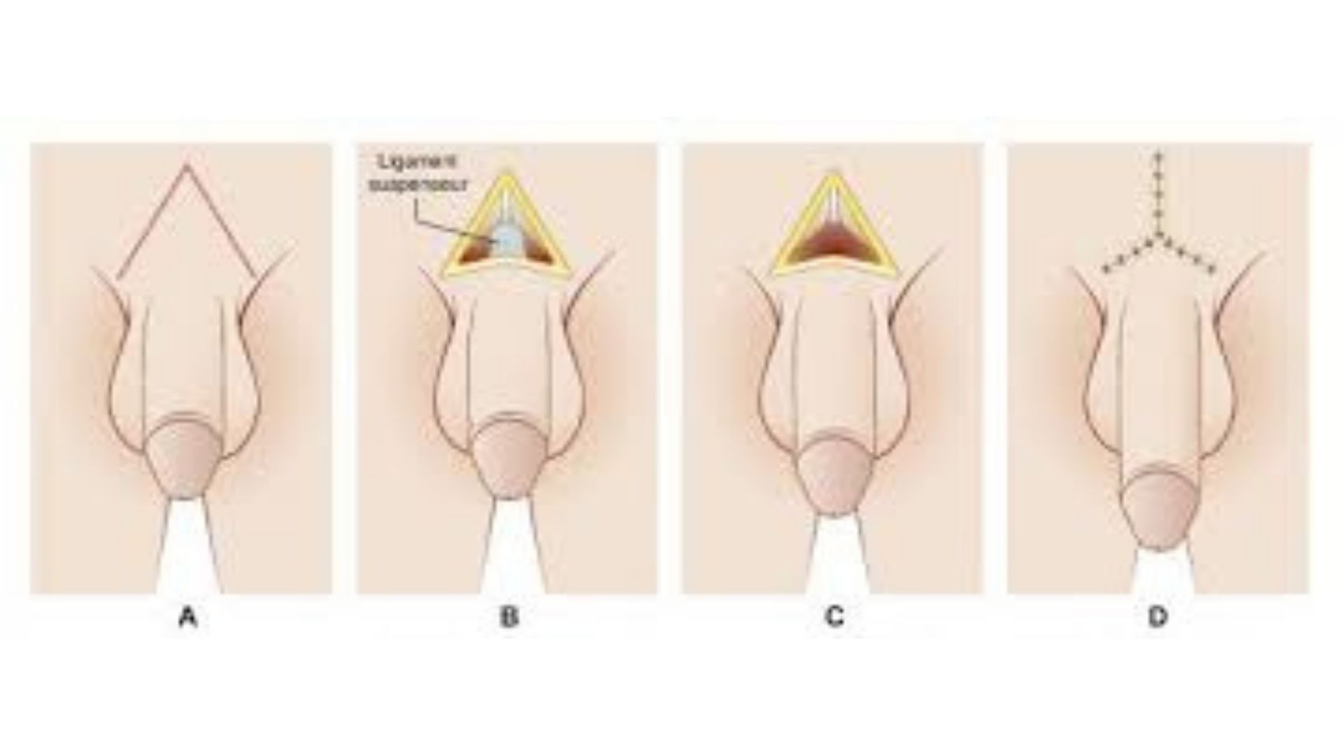 Penis Buyutme Ameliyati Nedir