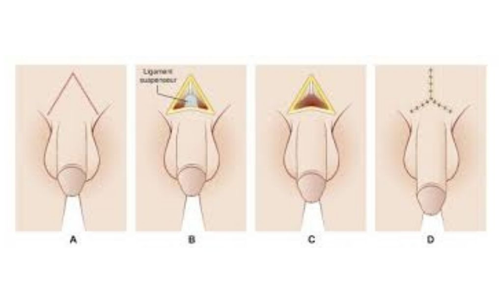 Penis Buyutme Estetigi