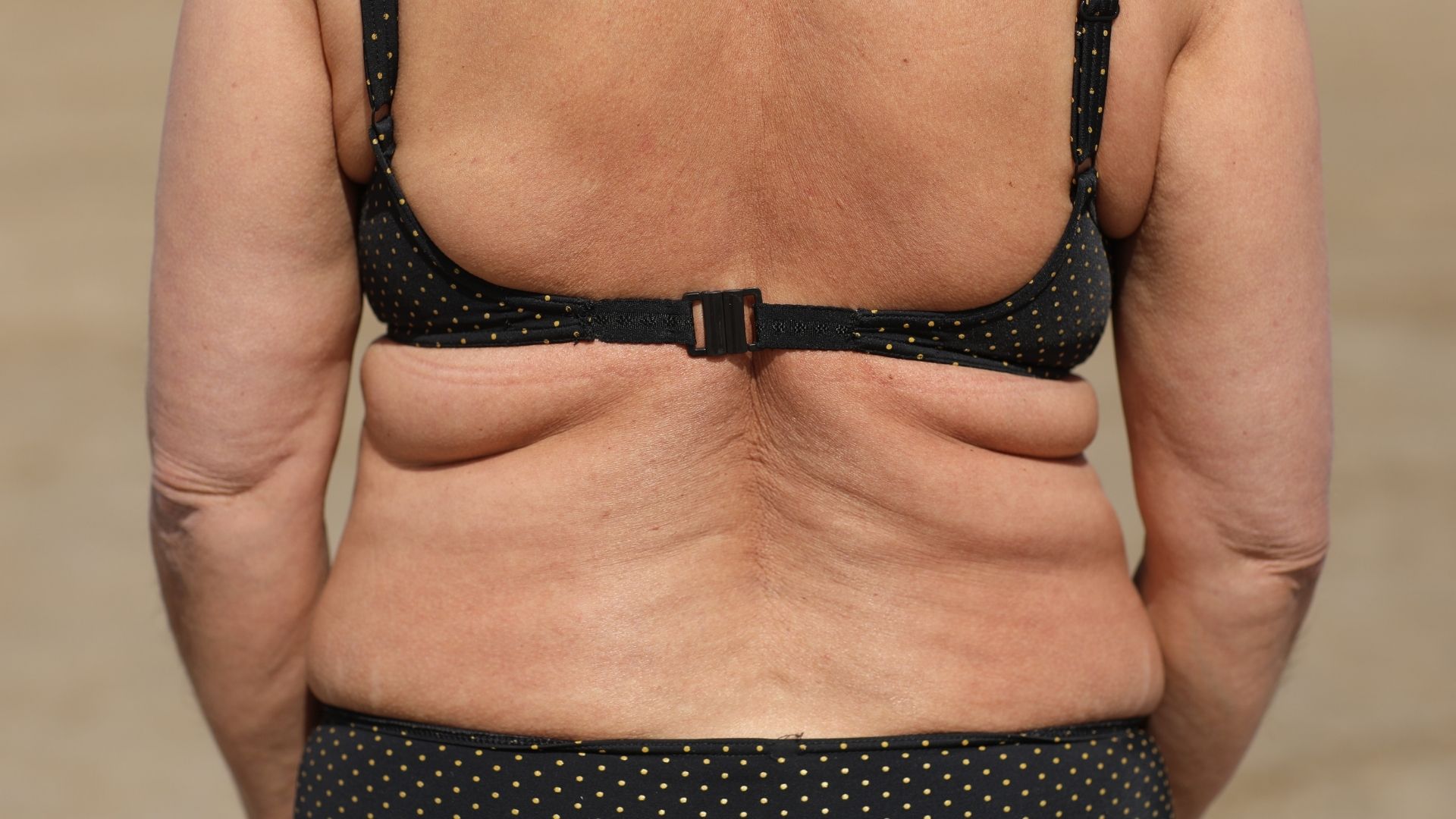 Who is Back Lift Surgery Suitable for