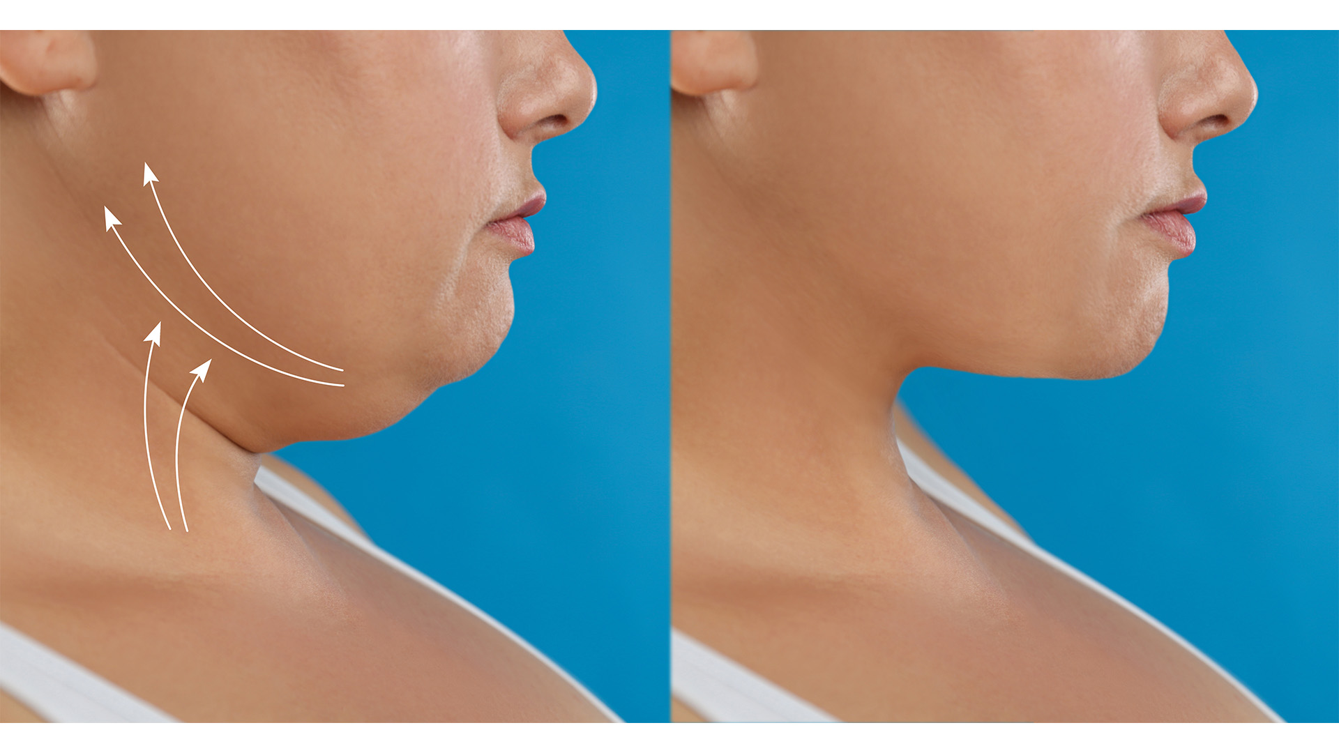 Neck Lift 2 neck lift