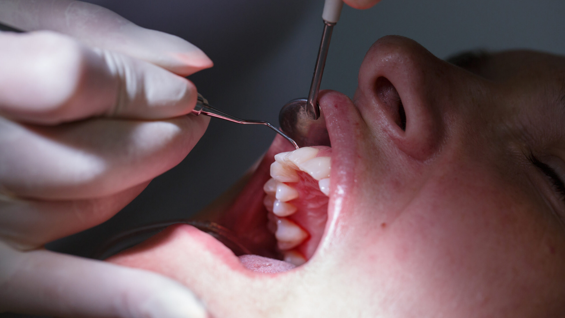 Esthétique gingivale 3 esthétique des gencives