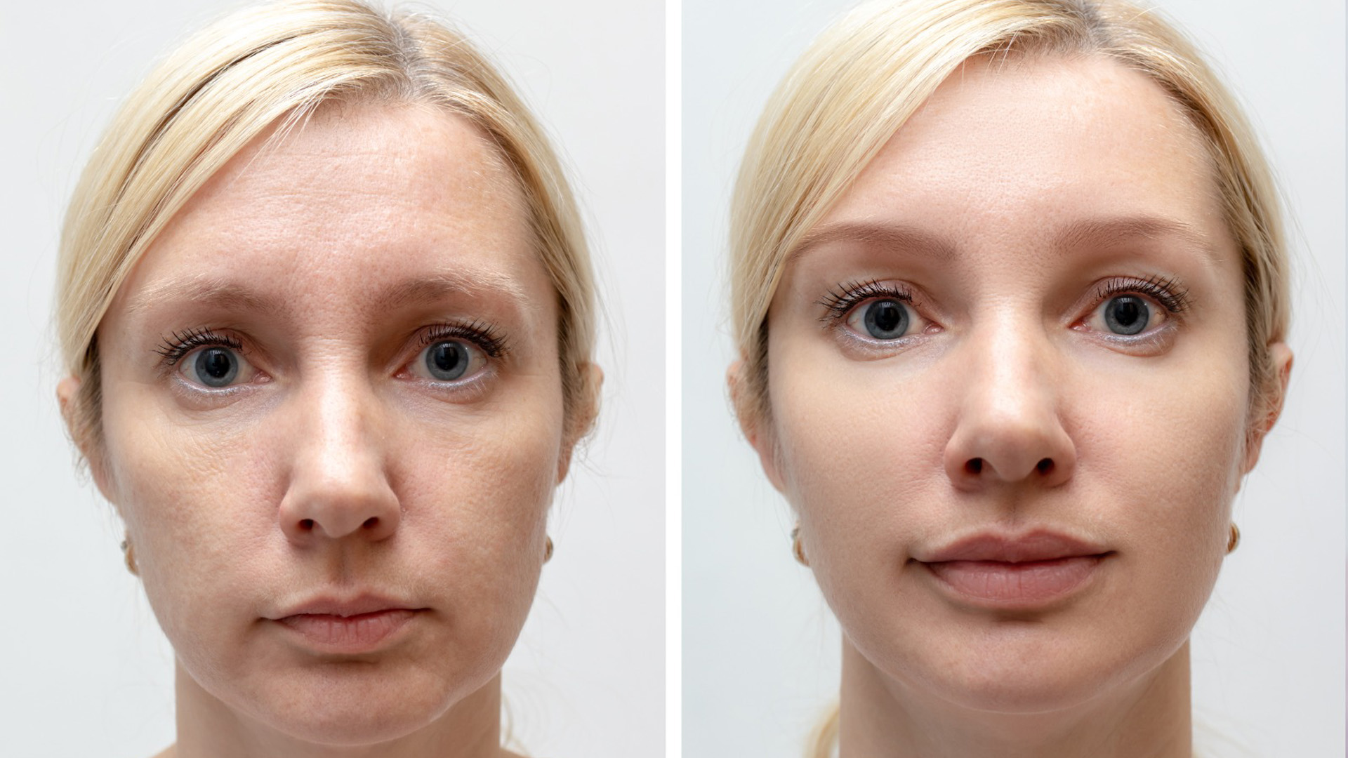 Lip Lift 2 lip lift