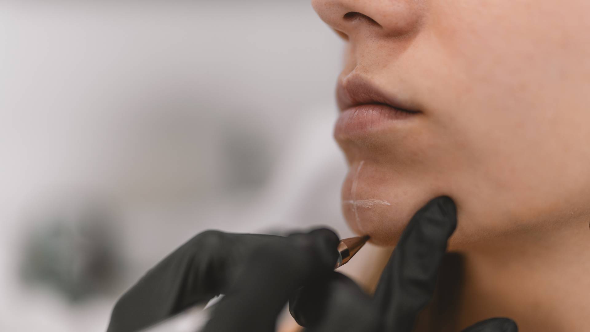 Chin Implant 2 Chin Implant