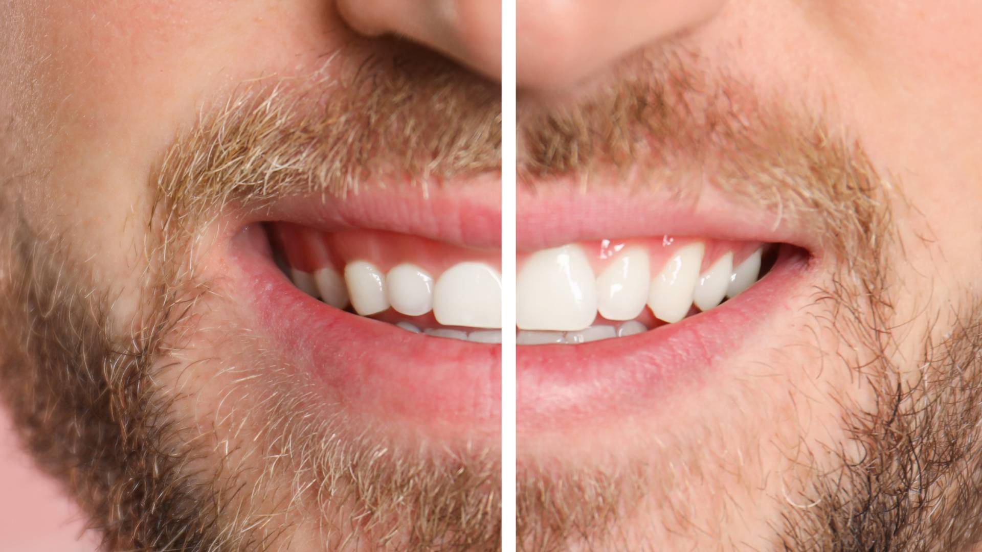 Esthétique gingivale 2 Esthétique gingivale