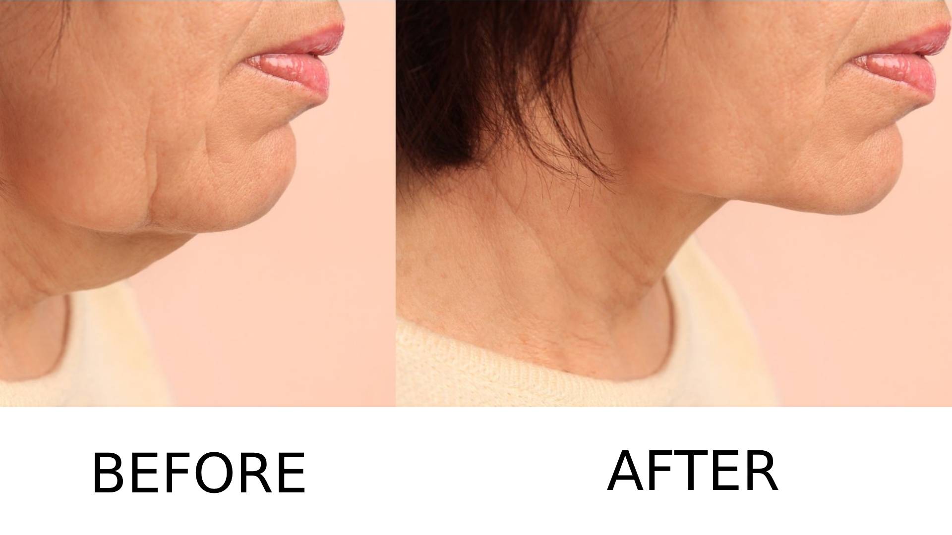 Face Lift 2 Face Lift