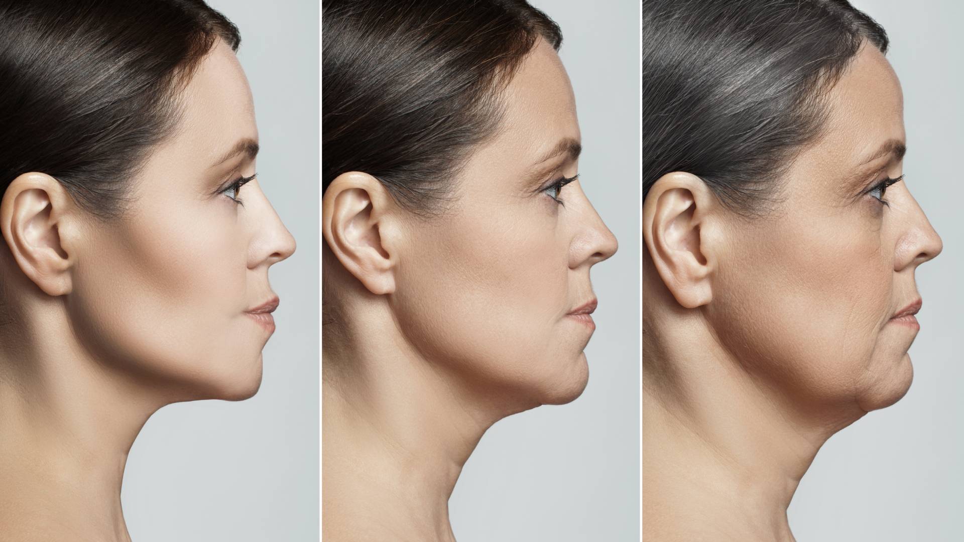 Neck Lift 3 Neck Lift