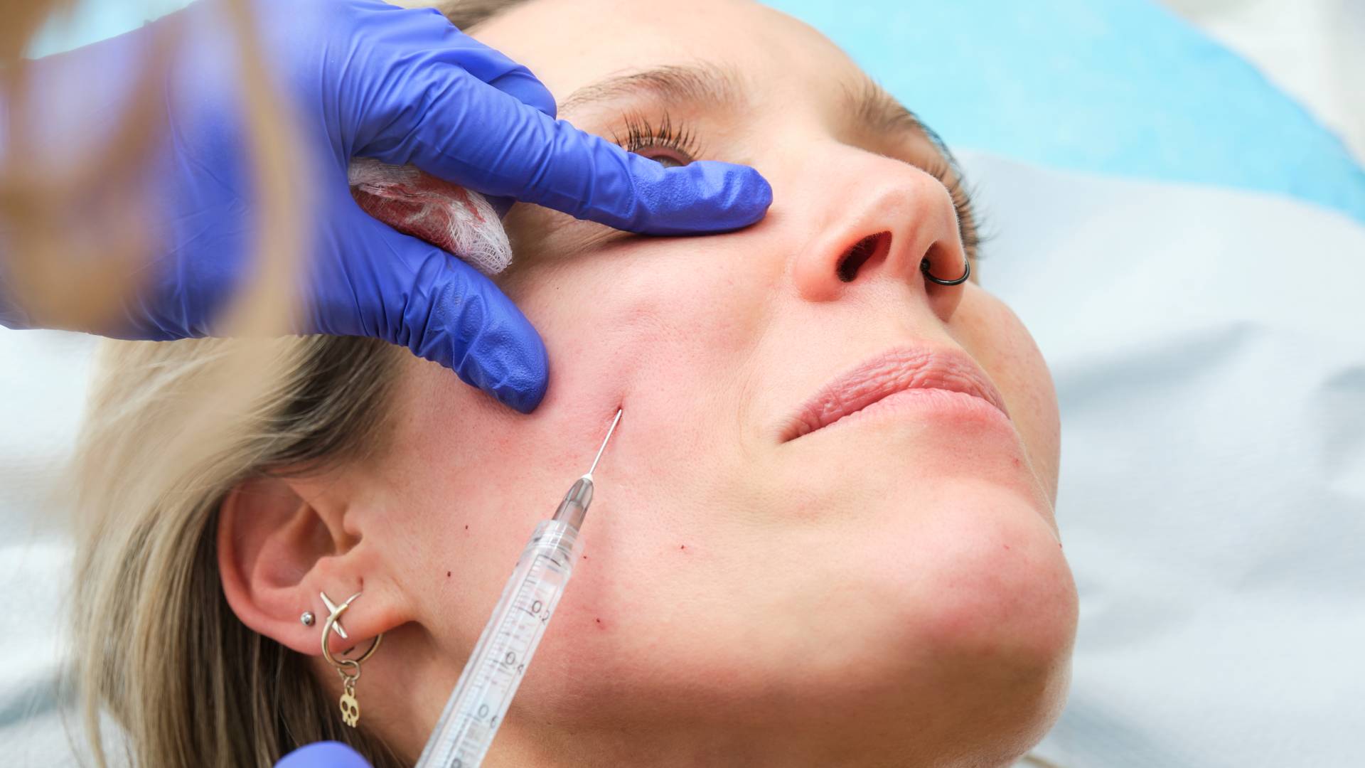 Facial Fat Injection 3 Facial Fat Injection