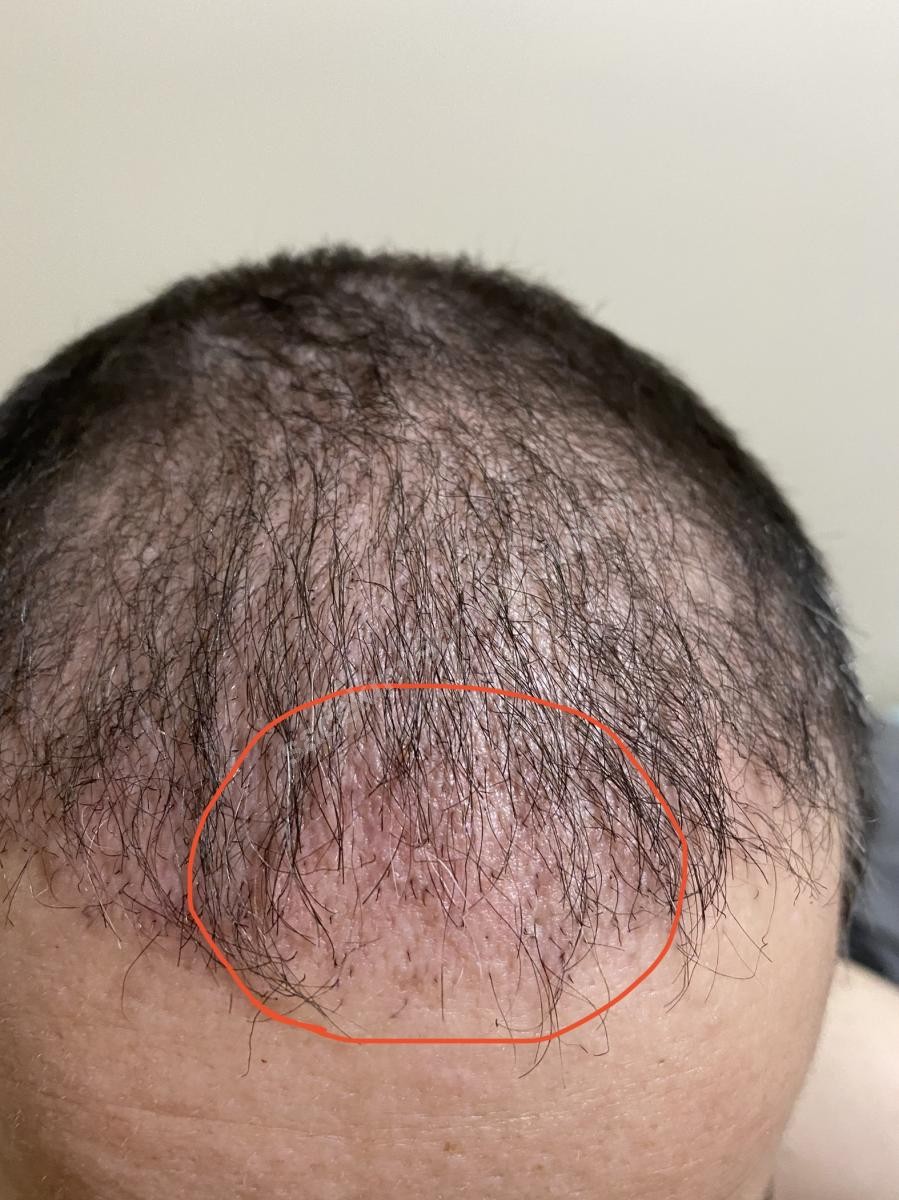 şok dökülme ne zaman biter