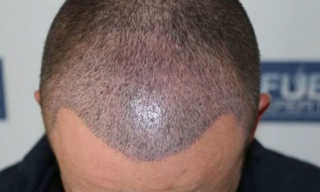 Saç Ekiminde Şok Dökülme Nedir ve Ne Zaman Biter?