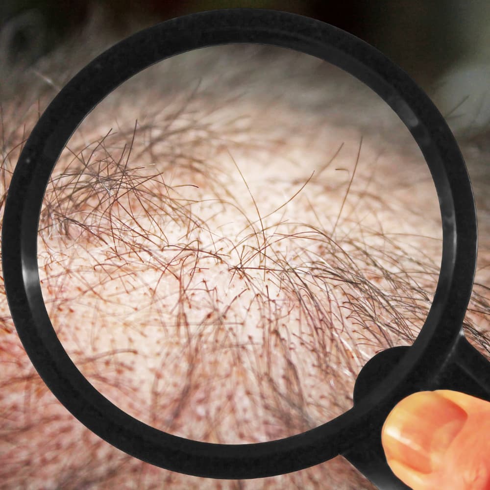 şok dökülme ne zaman biter